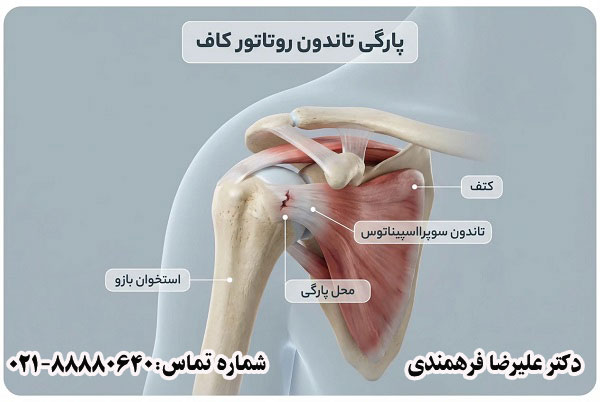 پارگی تاندون روتاتور کاف شانه