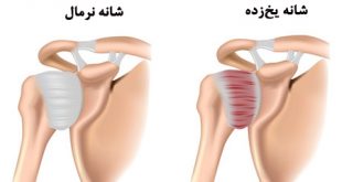 شانه منجمد چیست و چگونه درمان میشود | شیوه های درمان عارضه شانه منجمد یا یخ زده چیست؟