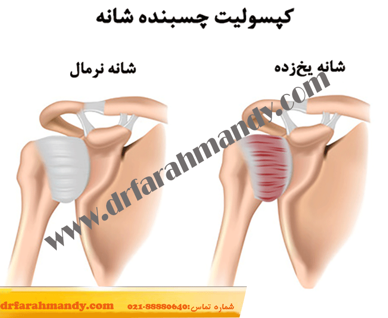 شانه منجمد چیست و چگونه درمان میشود | شیوه های درمان عارضه شانه منجمد یا یخ زده چیست؟