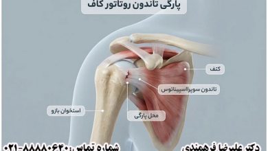 پارگی تاندون روتاتور کاف شانه