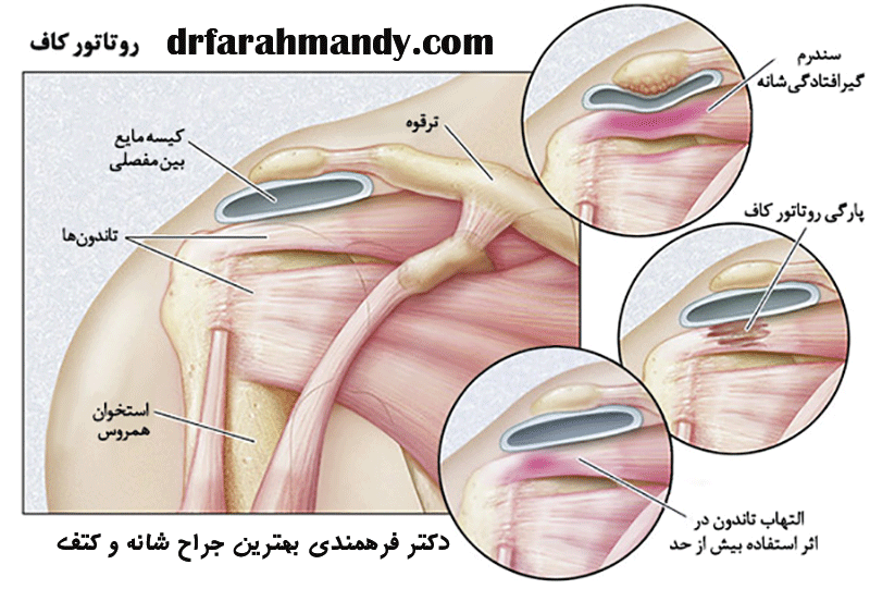 پارگی تاندون روتاتور کاف شانه