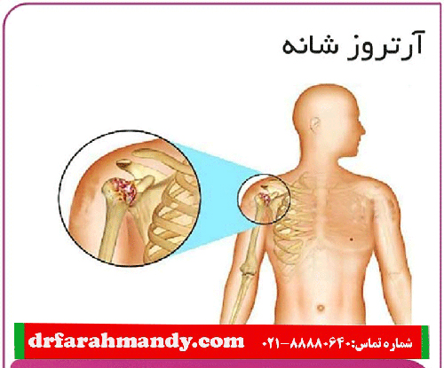 درمان آرتروز شانه به صورت قطعی + هزینه، دلایل و علائم ابتلا