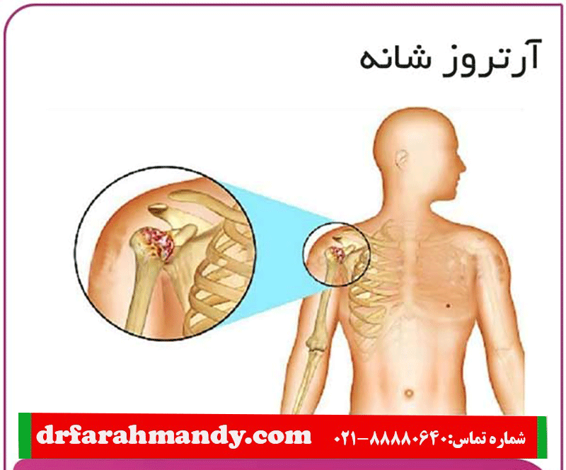 درمان آرتروز شانه