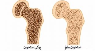 بیماری پوکی استخوان را بهتر بشناسید | علت ایجاد پوکی استخوان در بدن انسان | مراحل درمان پوکی