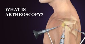 آرتروسکوپی چیست؟