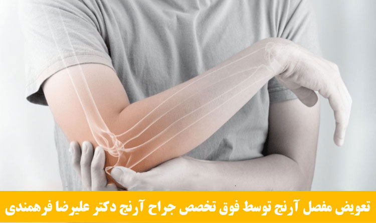 تعویض کامل مفصل آرنج