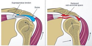 سندرم گیرافتادگی شانه