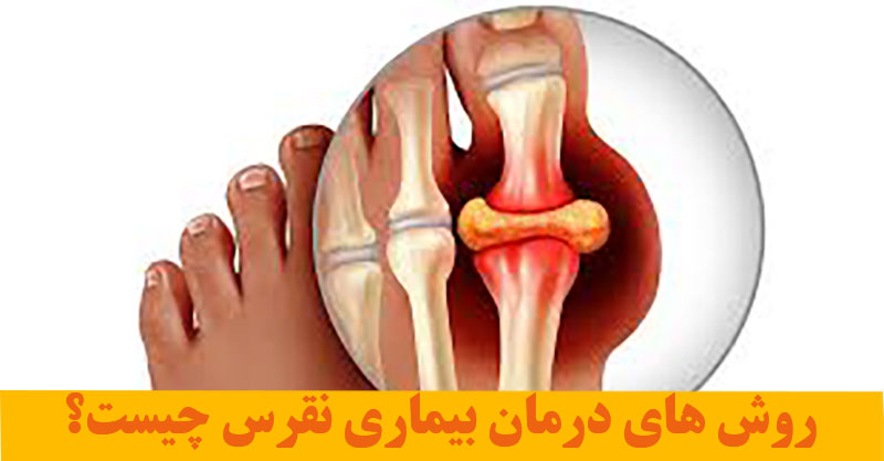 روش های درمان بیماری نقرس