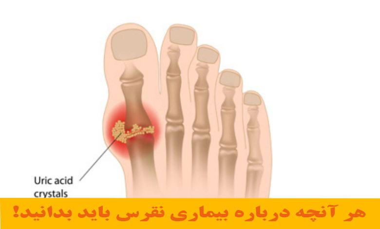 بیماری نقرس