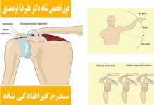 سندرم گیرافتادگی شانه