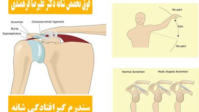سندرم گیرافتادگی شانه