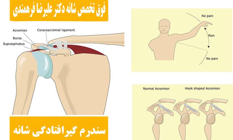 سندرم گیرافتادگی شانه