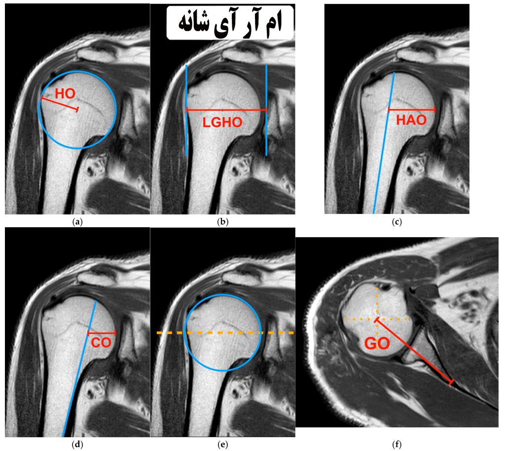 هزینه ام آر ای شانه (MRI)