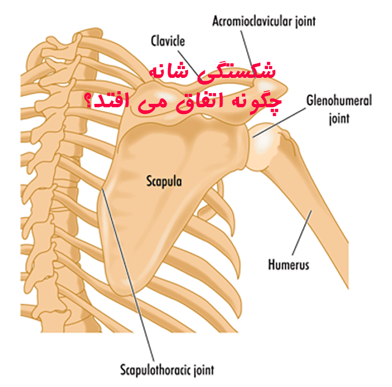 شکستگی شانه