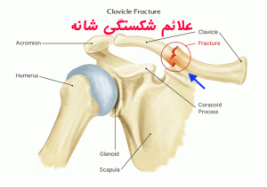 شکستگی شانه