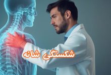 شکستگی-شانه