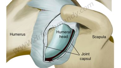 پارگی کپسول مفصل شانه چیست؟